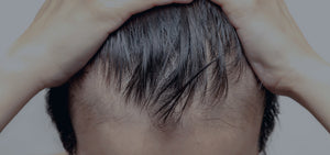 7 Natural Treatments for Male Pattern Baldness [2018 Edition]